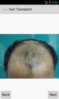 Hair Transplant Calculator