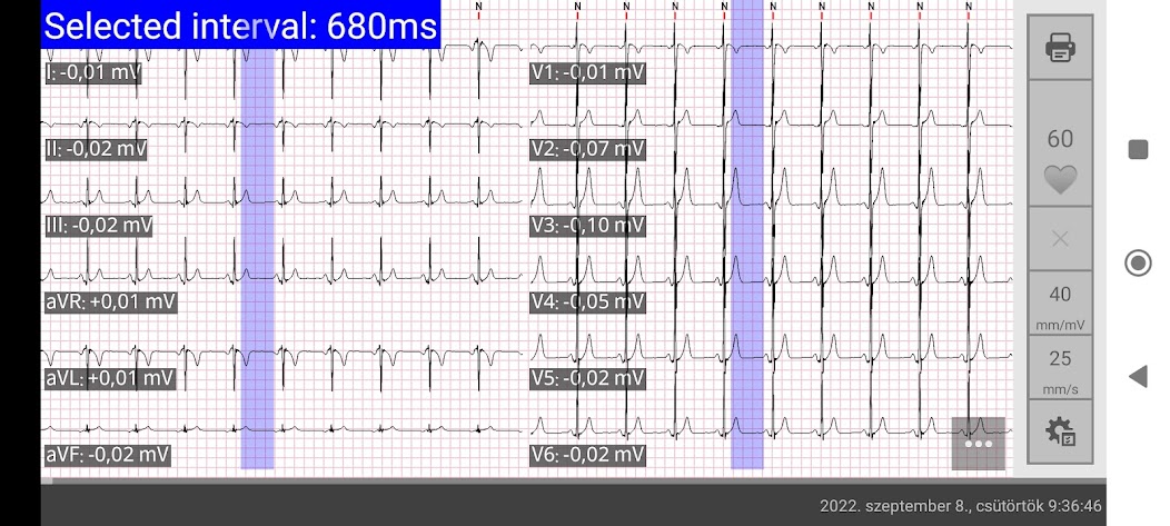 Cardiospy Mobile ECG