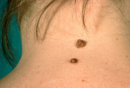 Moles and Warts Removal